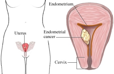 Tumor Uterus